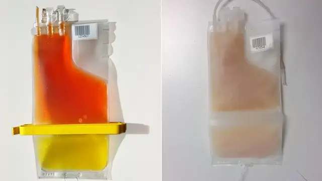 A side-by-side comparison of two medical blood product bags, one containing a red and yellow fluid mixture which are the fresh platelets and the other a more translucent, pale substance, representing the frozen platelets.